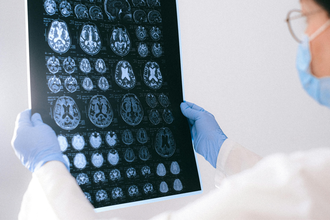 woman with blue mask and blue gloves holding up brain scan images